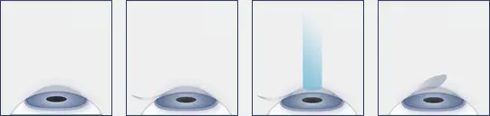 LASIK diagram without captions