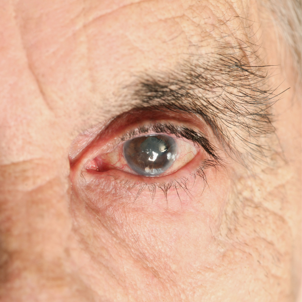 Image representing cataracts.