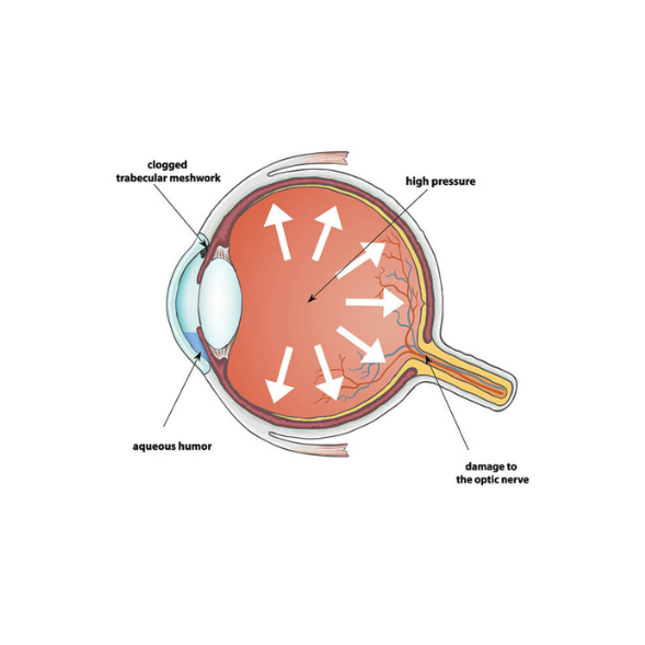 Image representing glaucoma.