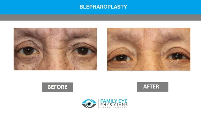 Before and after images of eye treatment showing improvement.