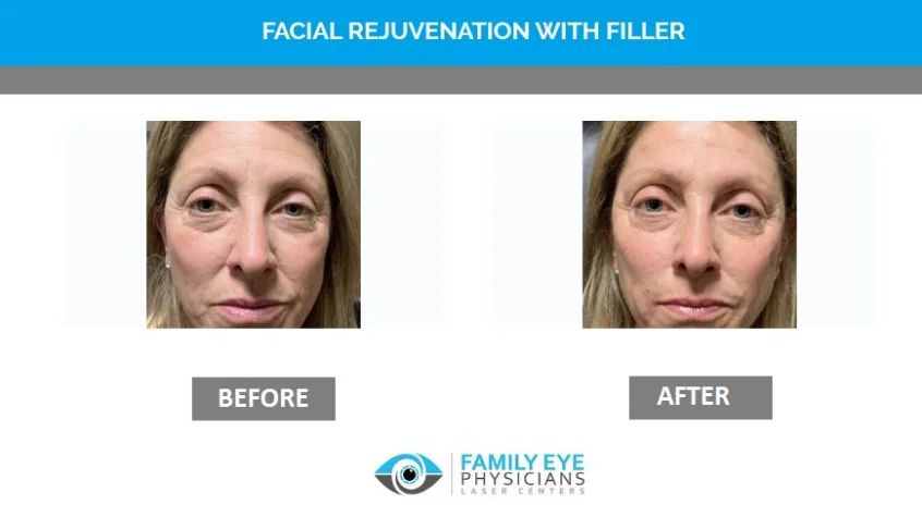Before and after images of eye treatment showing improvement.